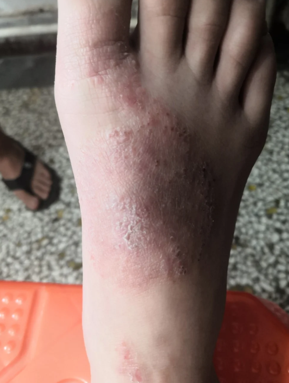 脚背发痒一抓就起很多小疙瘩,最常见的原因是皮肤过敏或真菌感染