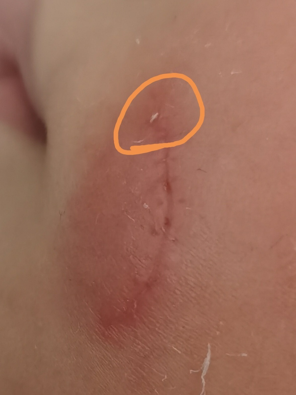 宝宝拆线一个月出现了线头排异反应 最开始以为是伤疤上长了一个米米