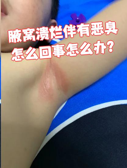 腋窝溃烂有臭味,可能是间擦疹,慢性湿疹,皮炎,化脓性汗腺炎或臭汗症