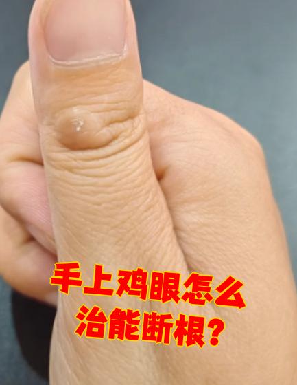 手上长"鸡眼"的说法不对,鸡眼通常长在脚上