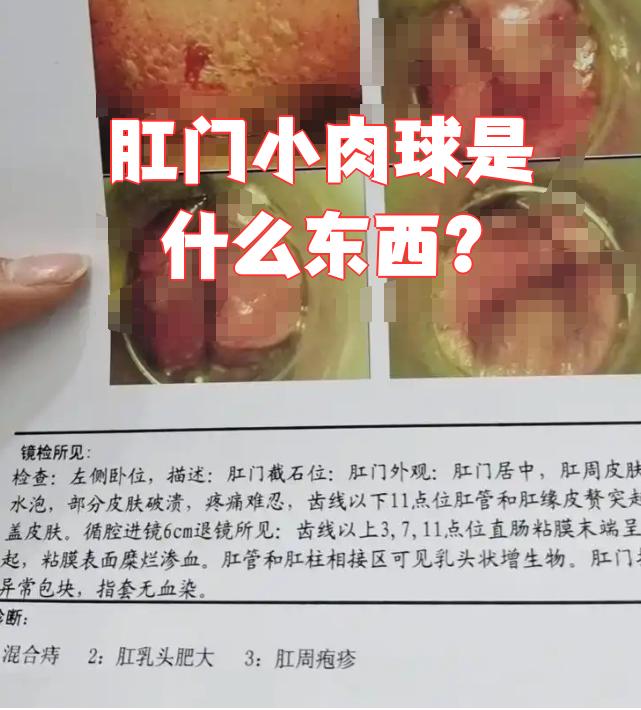 肛门长小肉球最常见的原因是痔疮或直肠息肉
