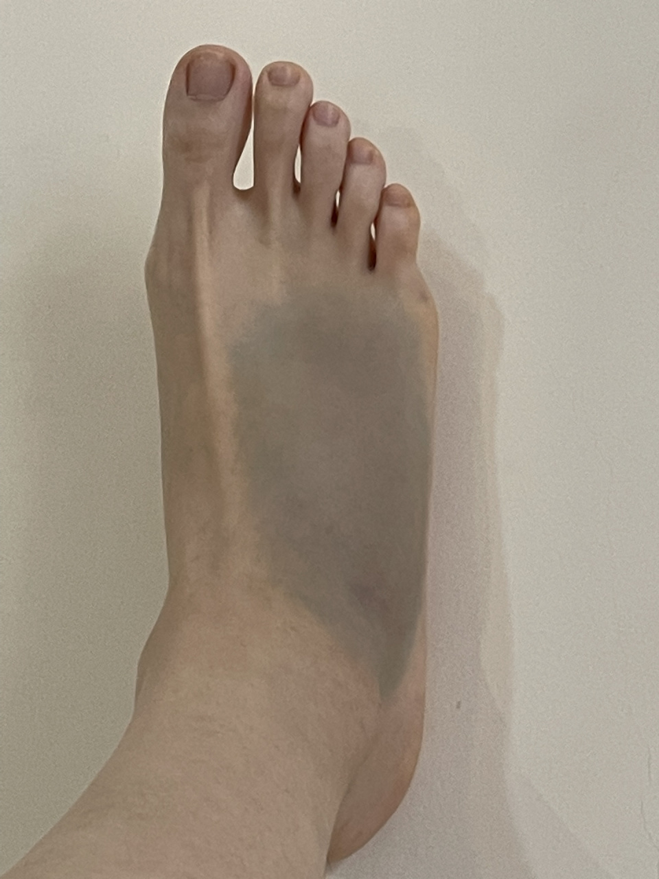 崴脚day 2- day 10 淤青逐渐扩散 肿胀的最高点摸起来硬硬的,变换姿势