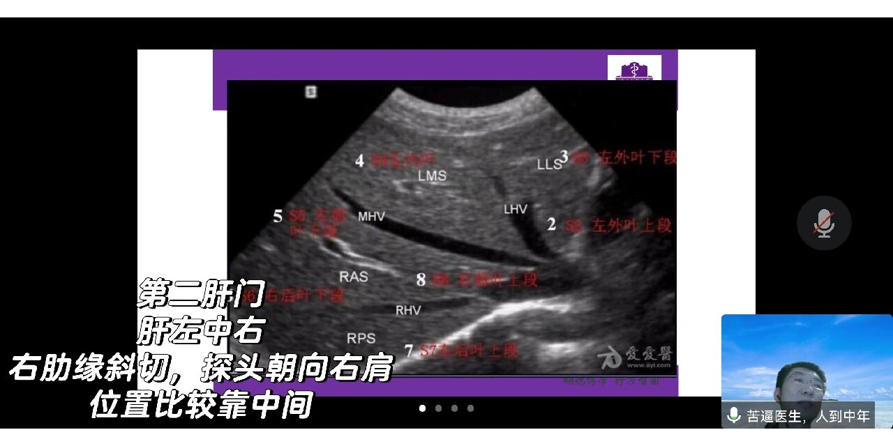 肝脏超声1(工字形,第一肝门,第二肝门)