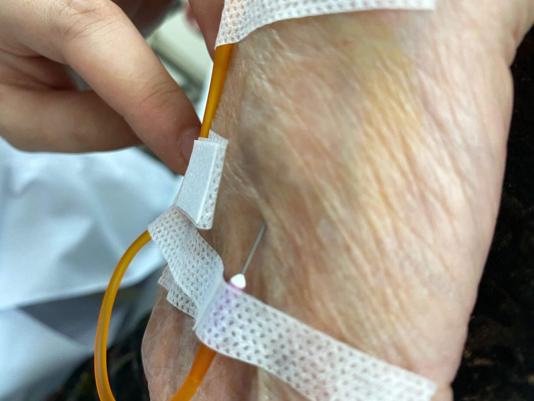 今天给一位70多岁的奶奶扎滴流,刚扎进去不一会,奶奶说有滋拉滋啦的