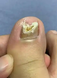 脚大拇指甲发黑像有淤血,常见原因包括灰指甲,外伤和营养不良