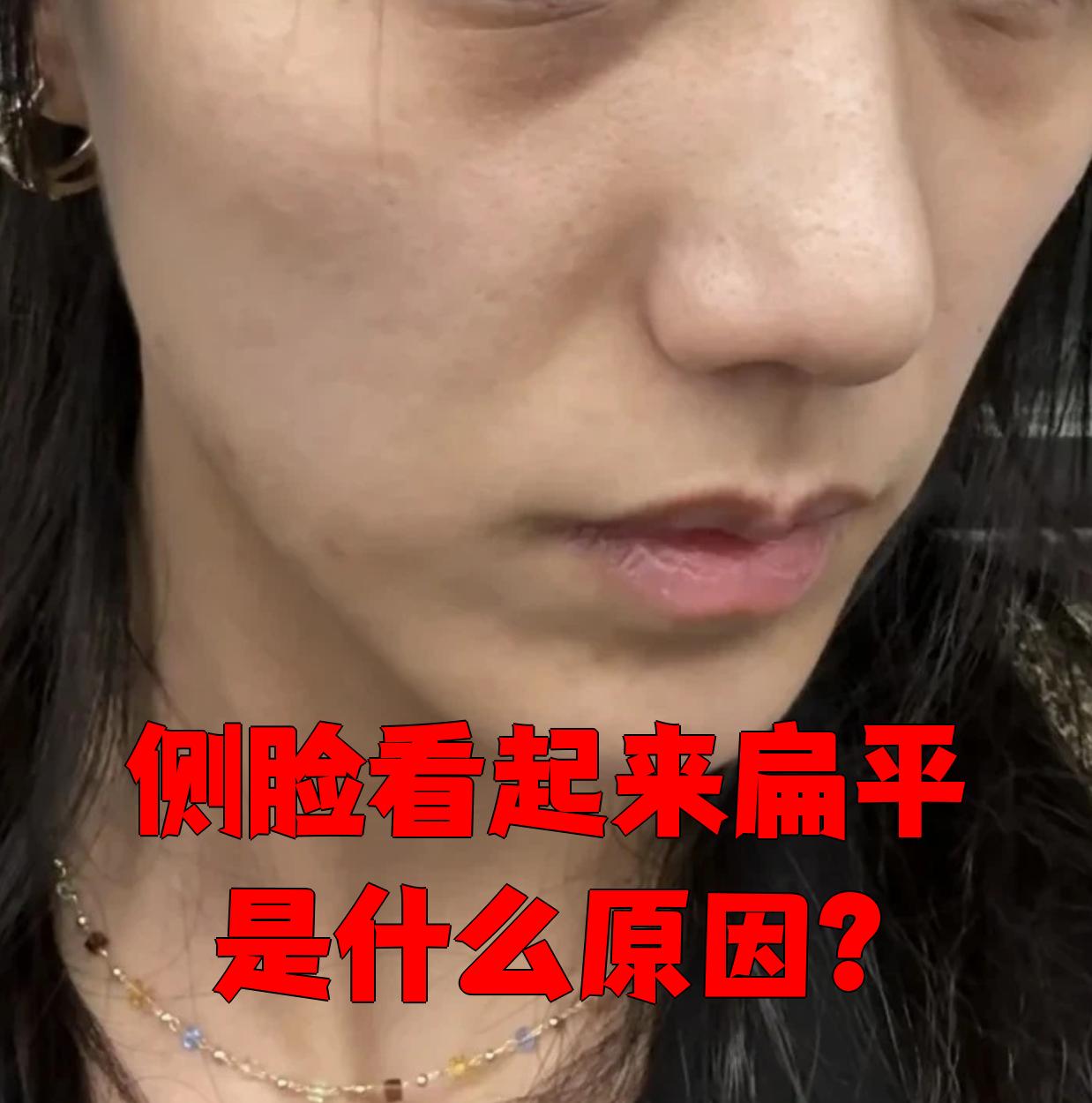 侧脸看起来扁平可能和肥胖,鼻子不挺拔,苹果肌先天性发育不良,外伤