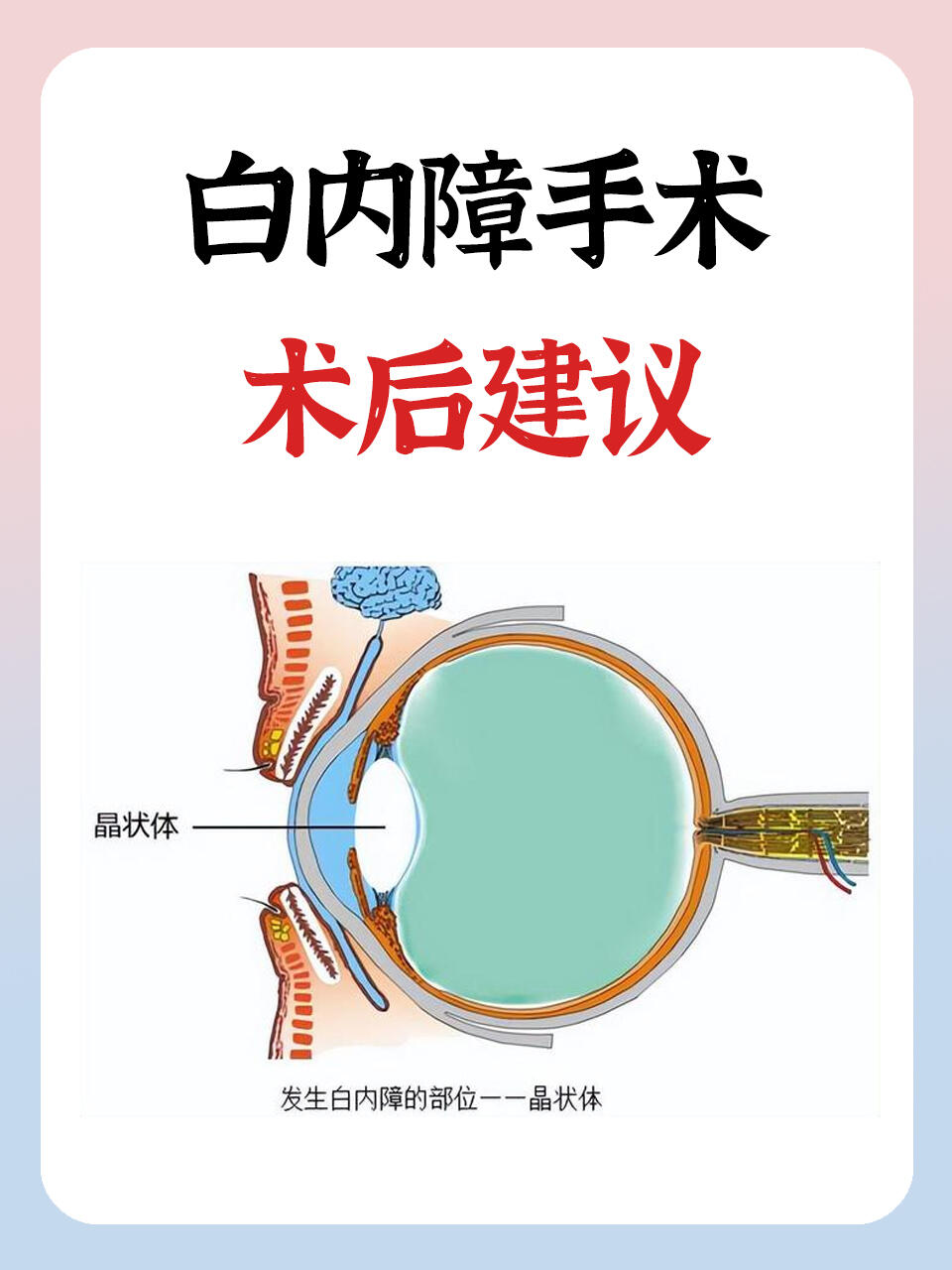 白内障手术几天能出院图片