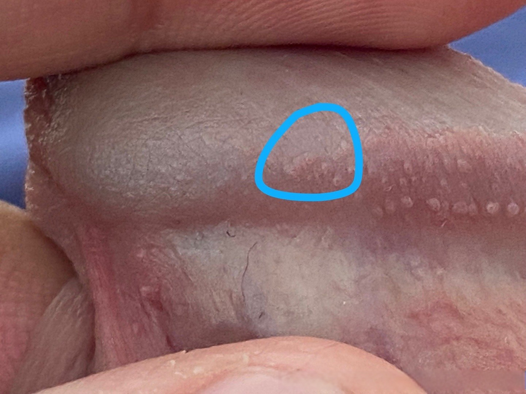 皮肤科##微博健康公开课# 高医生,蓝色画圈里这挨着的3颗也是珍珠疹吗