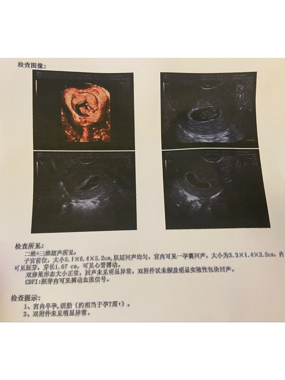 怀孕早期,妊娠囊/孕囊偏右宫角?