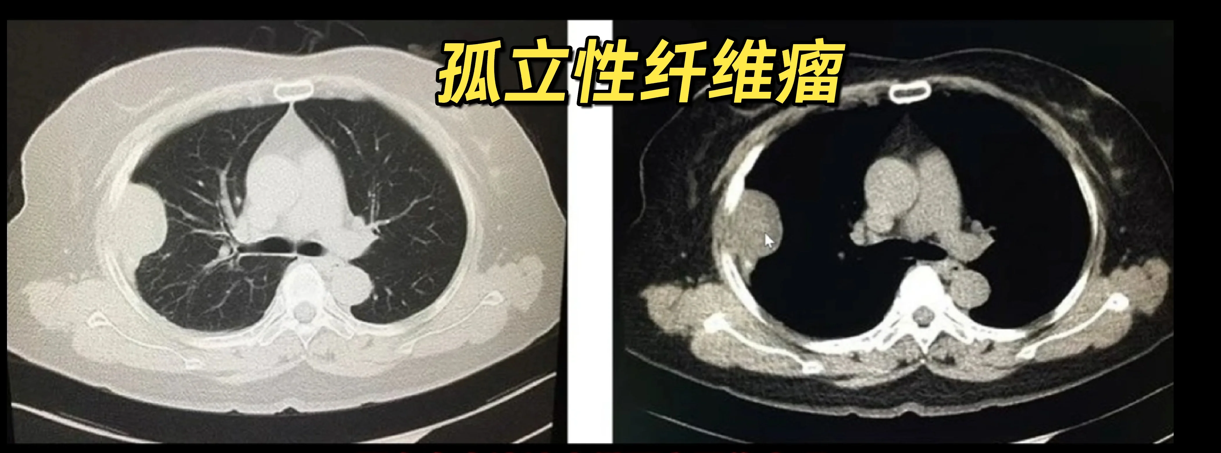 孤立性纤维瘤 孤立性纤维瘤