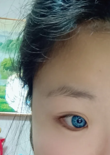 两只眼睛颜色不一样在医学上叫虹膜异色综合症,也可能是双眼晶状体