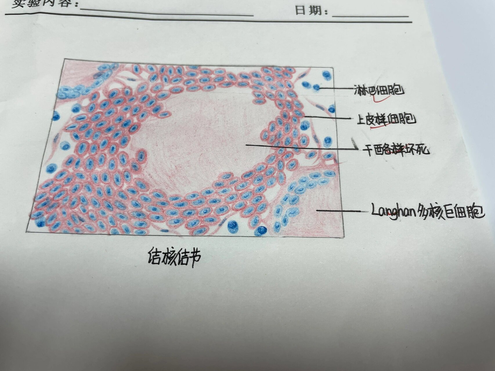 蜂窝织炎手绘图图片