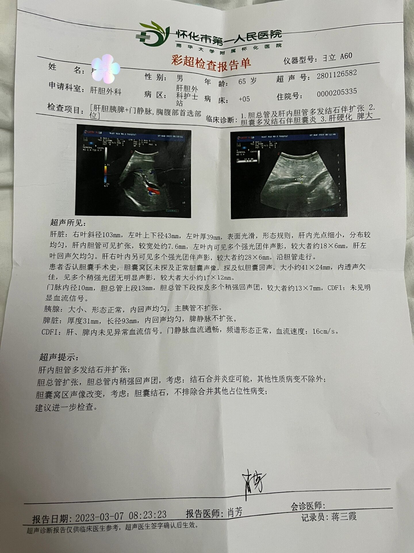 求帮忙,肝内胆管多发结石