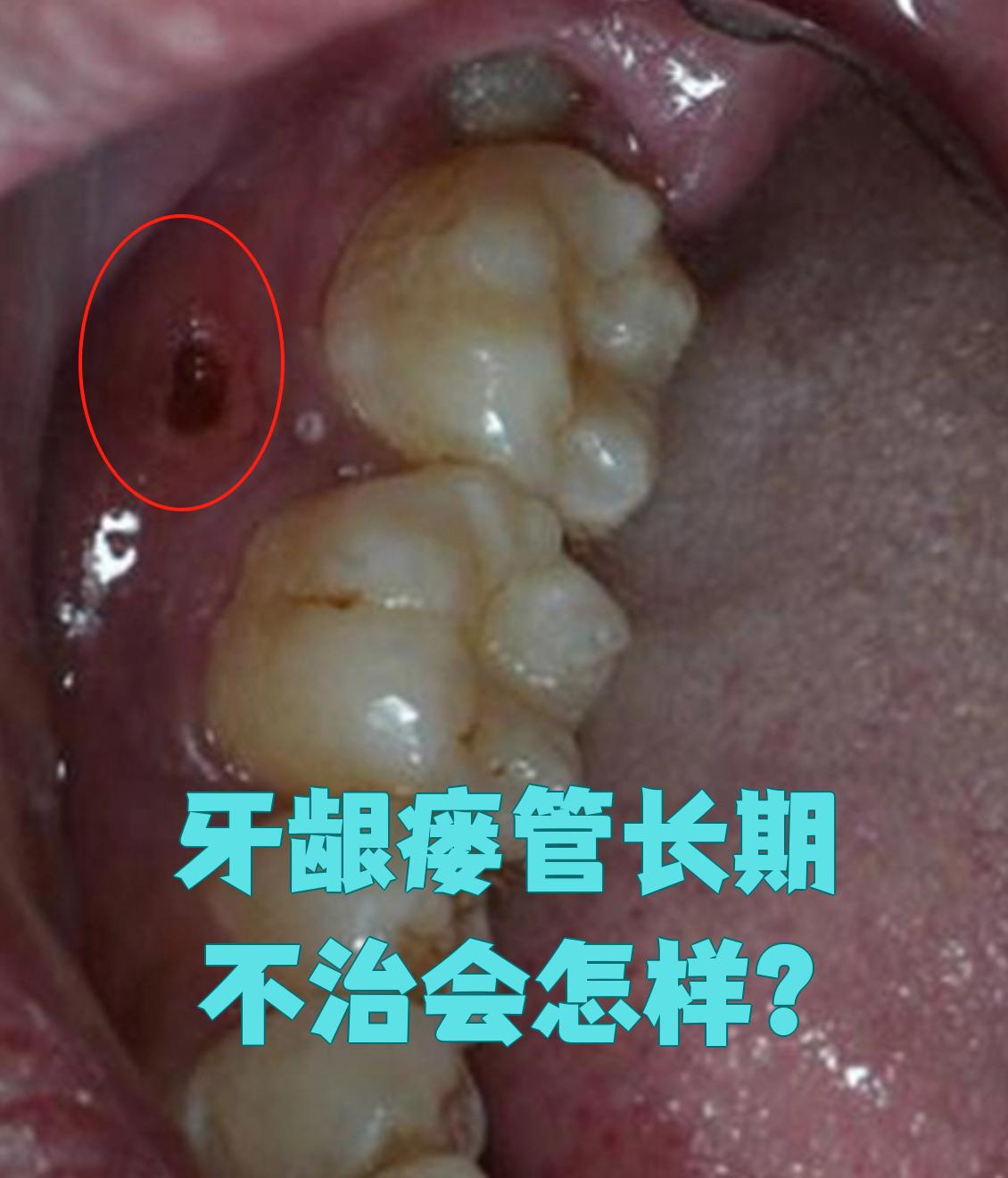 牙龈瘘管是根尖周炎的表现,如果一直不治疗会带来很多问题