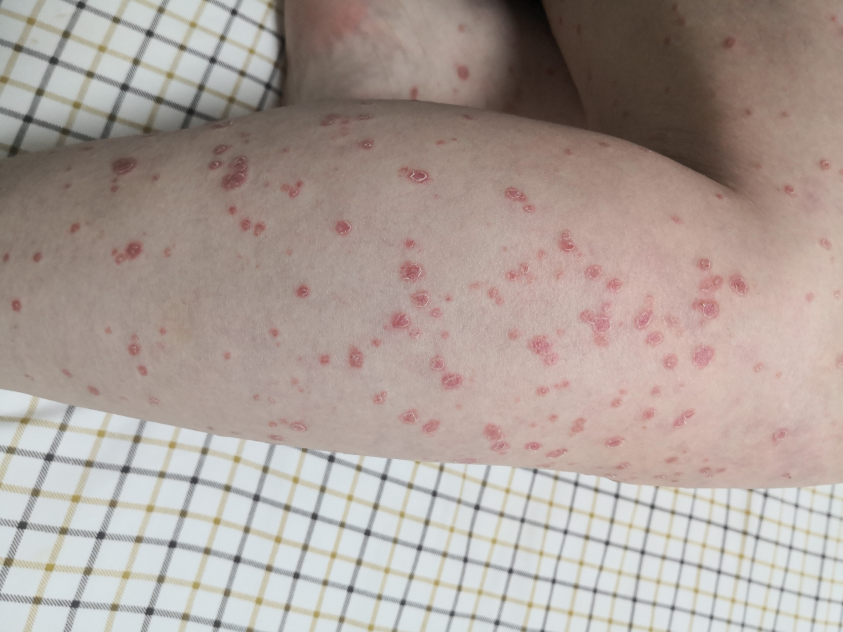 全身泛发红斑丘疹鳞屑性斑块.银屑病症状.