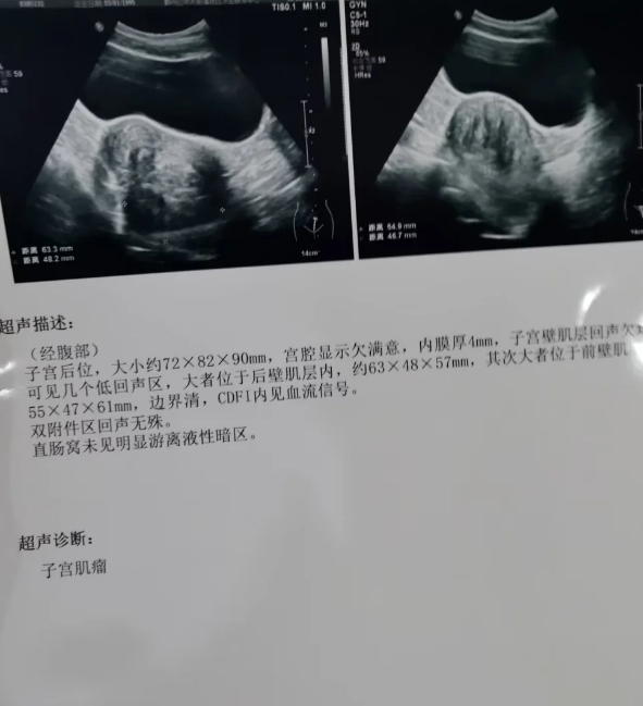 阴超就是通过阴道做的妇科超声,主要检查盆腔,子宫和附件的情况,看看