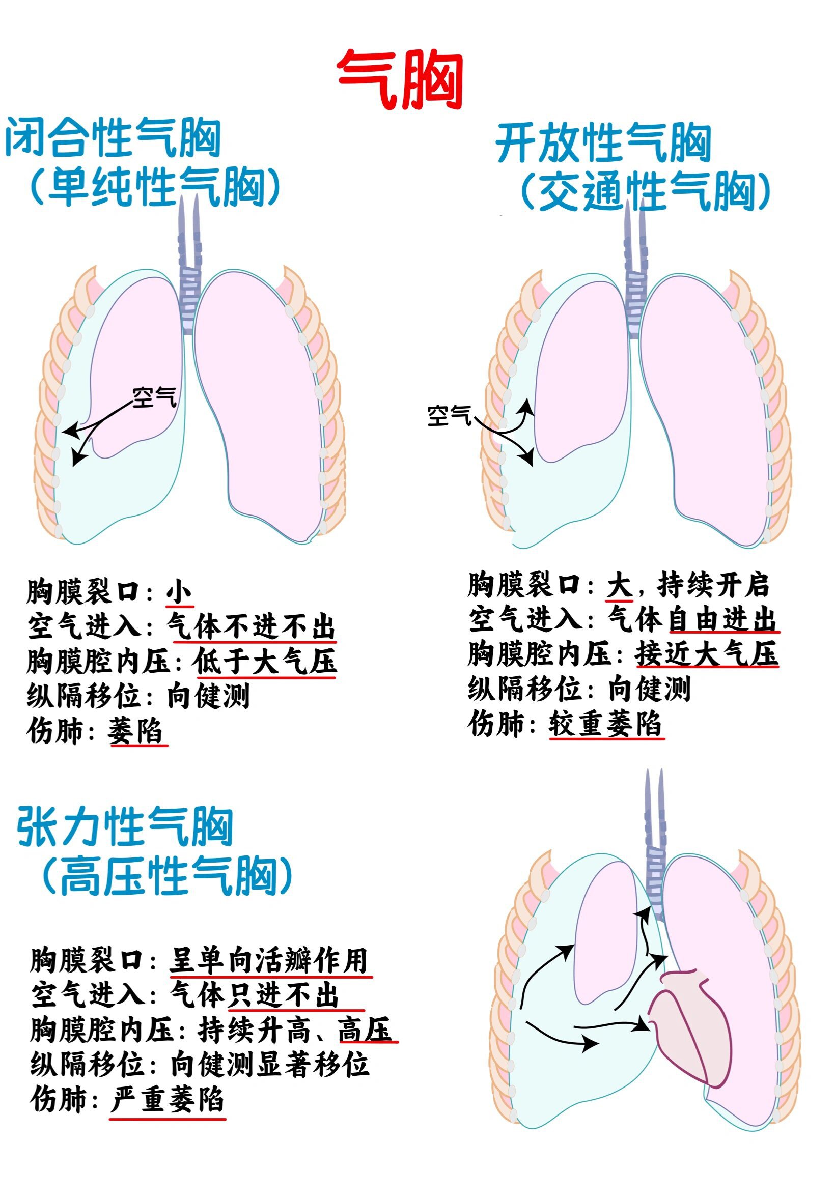 一文读懂三种气胸 气胸是指气体进入胸膜腔