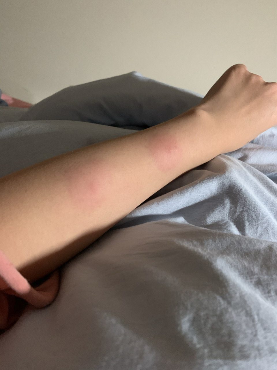 问下大家这是怎么回事01 今天突然胳膊就起倆大包,不痛不痒的,啊啊