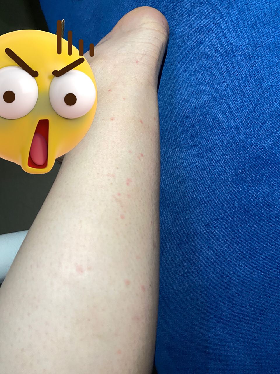 救命[笑哭][笑哭]洗澡的时候发现小腿上长了很多小红点,不痛不痒的