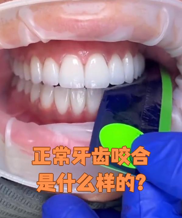 正常的牙齿咬合是指嘴巴自然闭合时,上下牙齿的正确位置关系