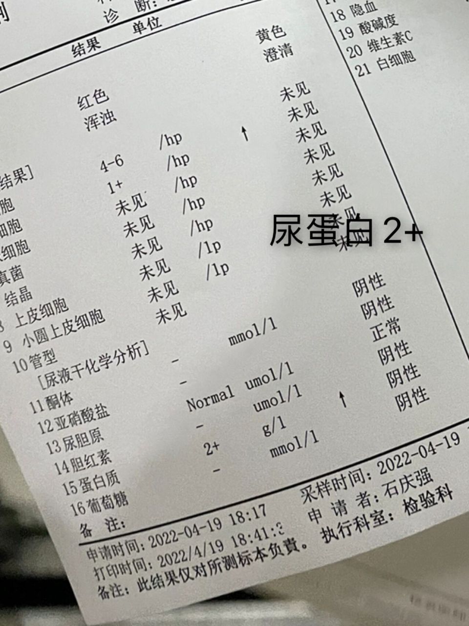 尿蛋白可能是尿路感染的原因 一周前突然尿血,查出急性尿路感染,尿