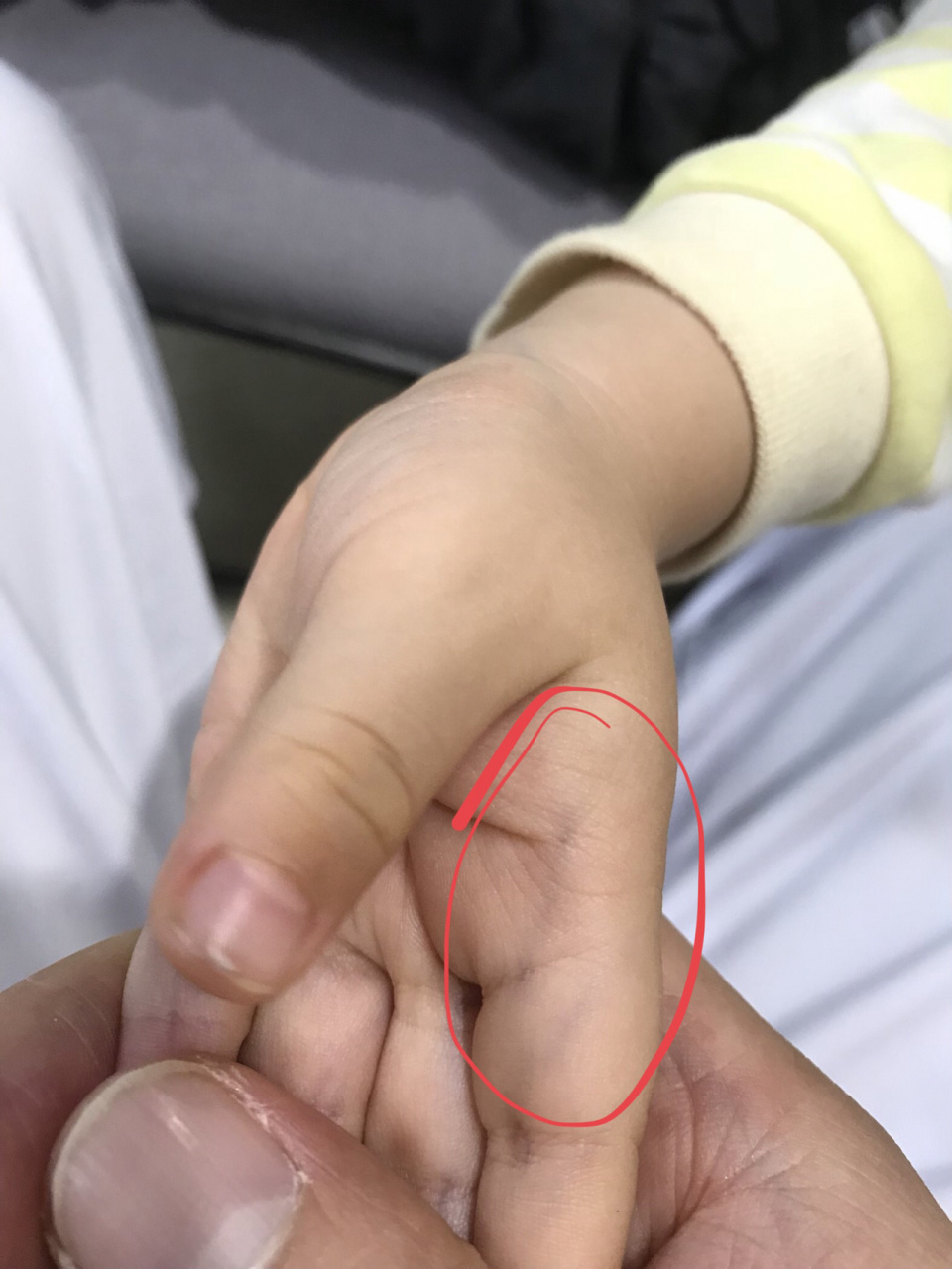 小儿指纹色紫红,家长要当心 小儿指纹的变化可以反映儿童的虚实寒热.