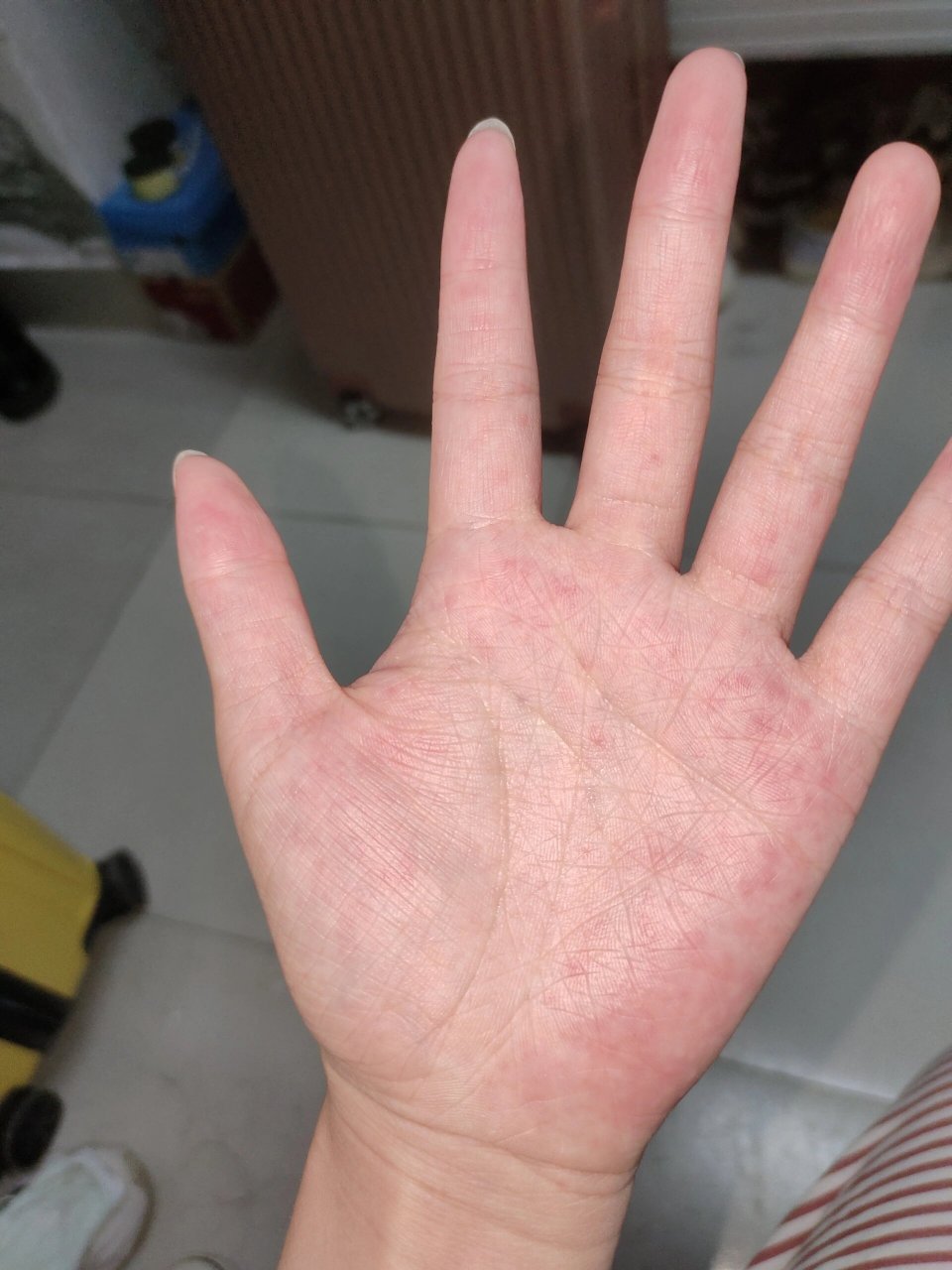 手心出现红疹,还痒