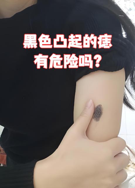 黑色凸起的痣大多数是良性的,一般不会恶变