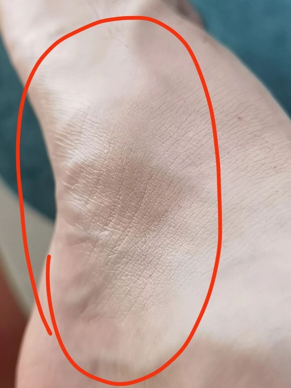 无缘无故脚内侧肿痛 前一晚上觉得按下去有点疼,就贴了膏药睡,结果
