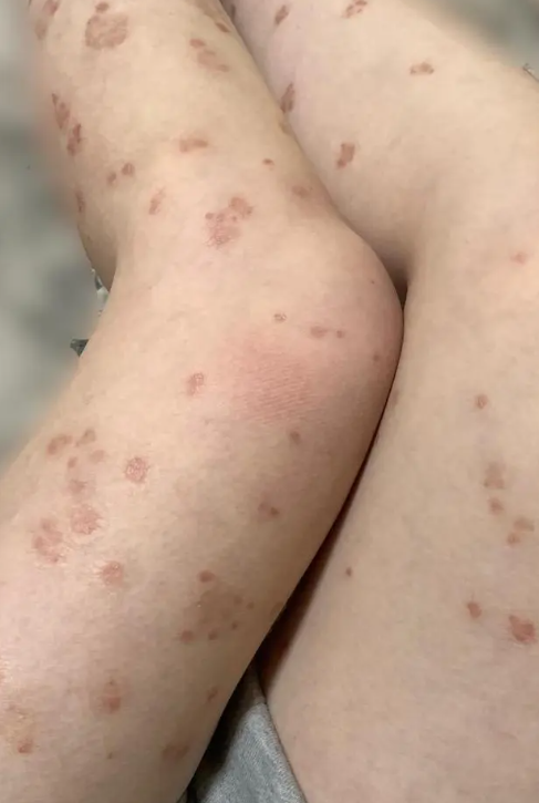 腿上出现一片癣并起白皮,最常见的原因是体癣,但也可能是银屑病或