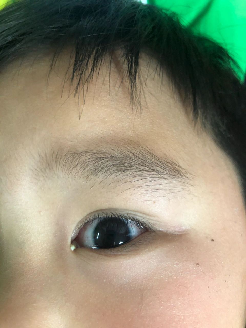 不知道宝宝这次是否是急性结膜炎,还是其他……上次眼睛又红又肿去