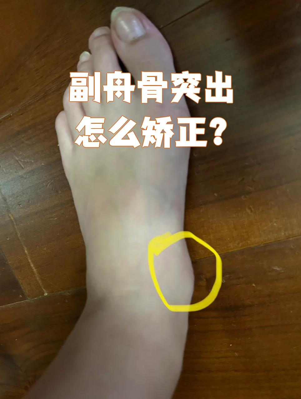 足副舟骨突出主要有三种矫正方法:理疗,石膏固定和手术治疗
