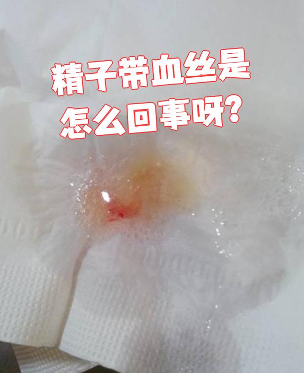 这种情况在医学上叫血精,最常见的原因是精囊炎或前列腺炎