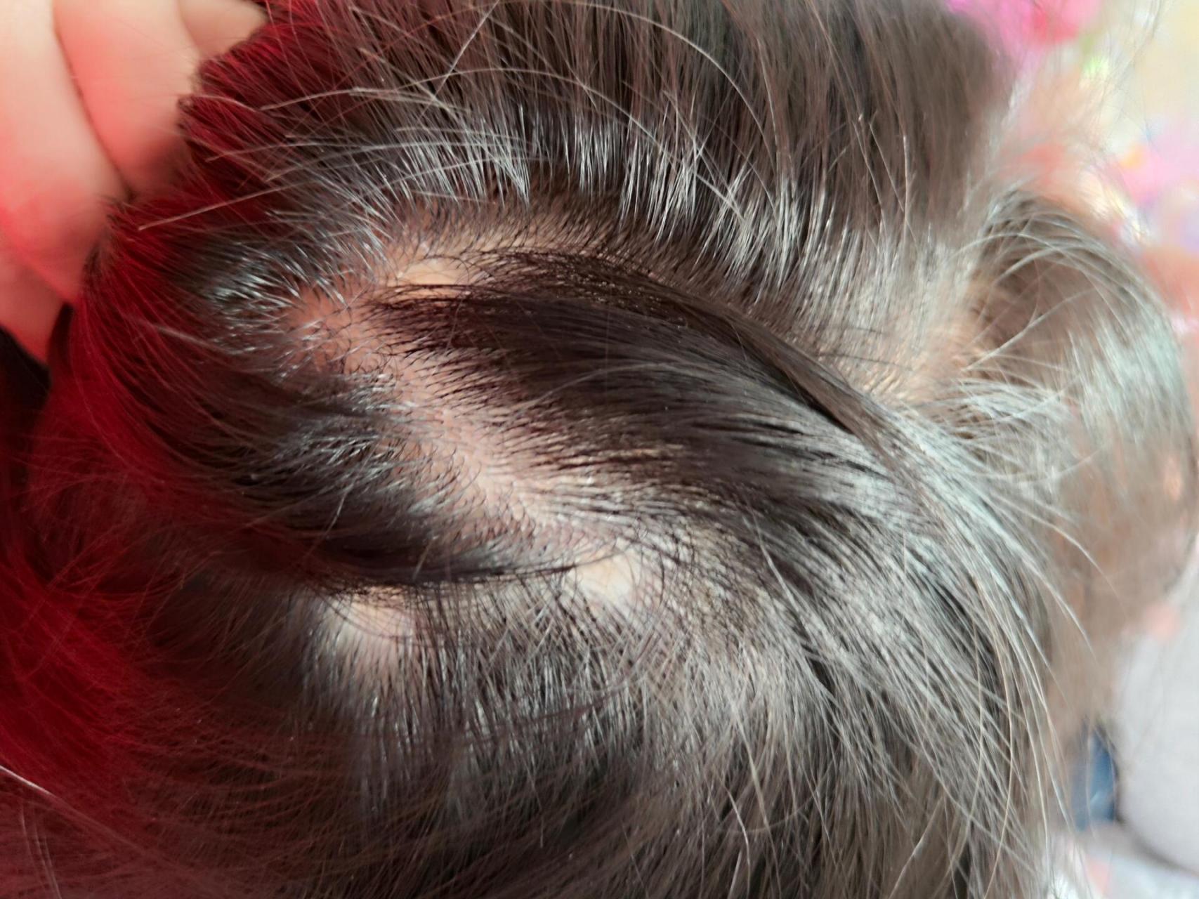 7岁女孩,掉发斑秃,急急急!