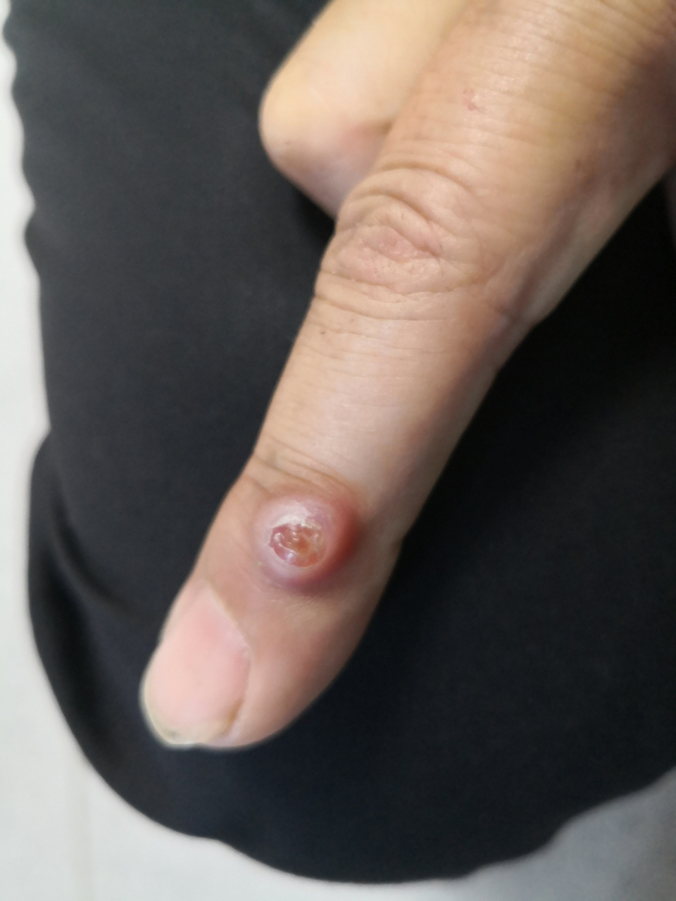 手指伸侧的囊肿样增生物.考虑黏液囊肿.#手术##活检