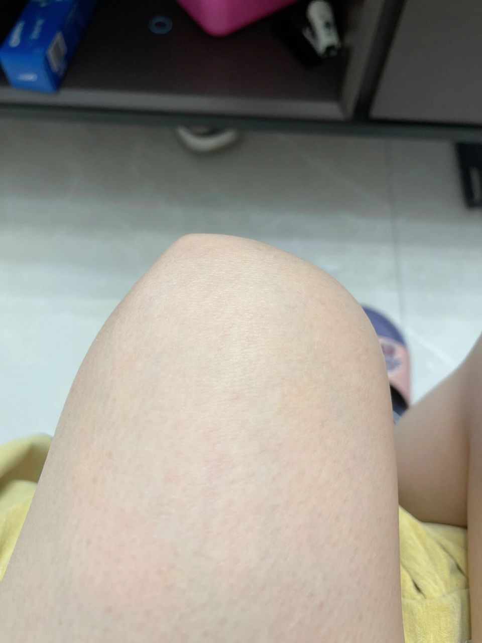 左右腿膝盖外侧骨头凸起,这是怎么回事