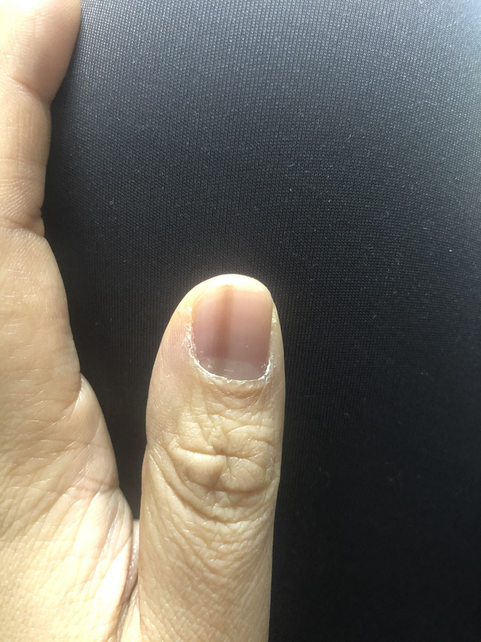 大拇指指甲有一条黑线图片