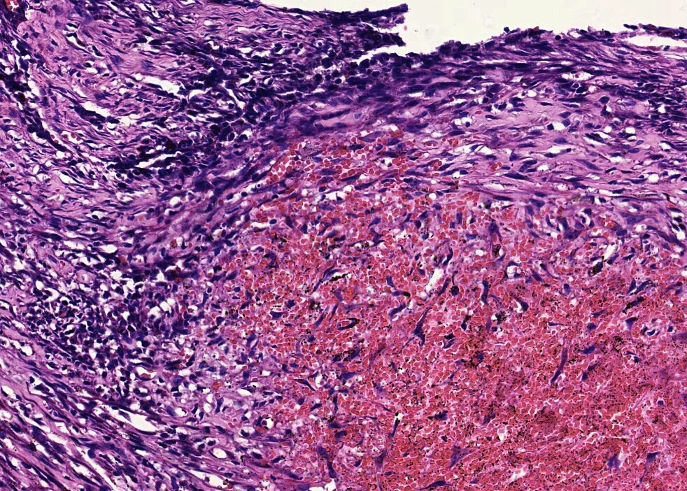 病理学实验切片,血栓机化和再通