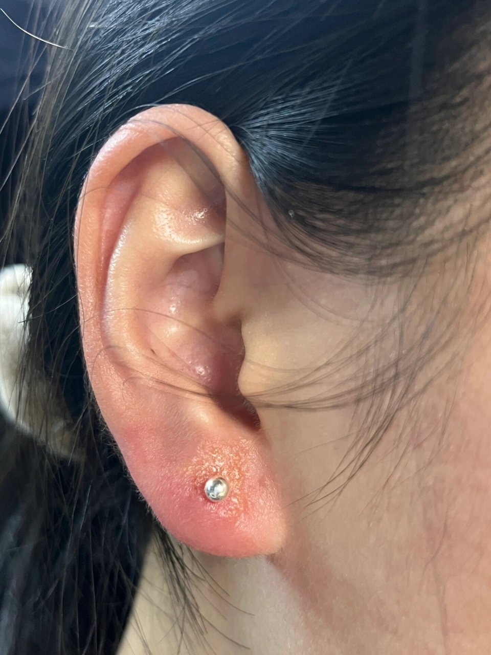 小水泡🥺🥺🥺 打完耳洞快一周了,耳朵旁边起了一串小水泡,睡