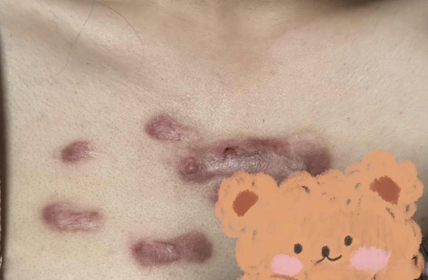 目前疤痕疙瘩的治疗方法有很多,如激光,手术,打针等,但以上单一的治疗