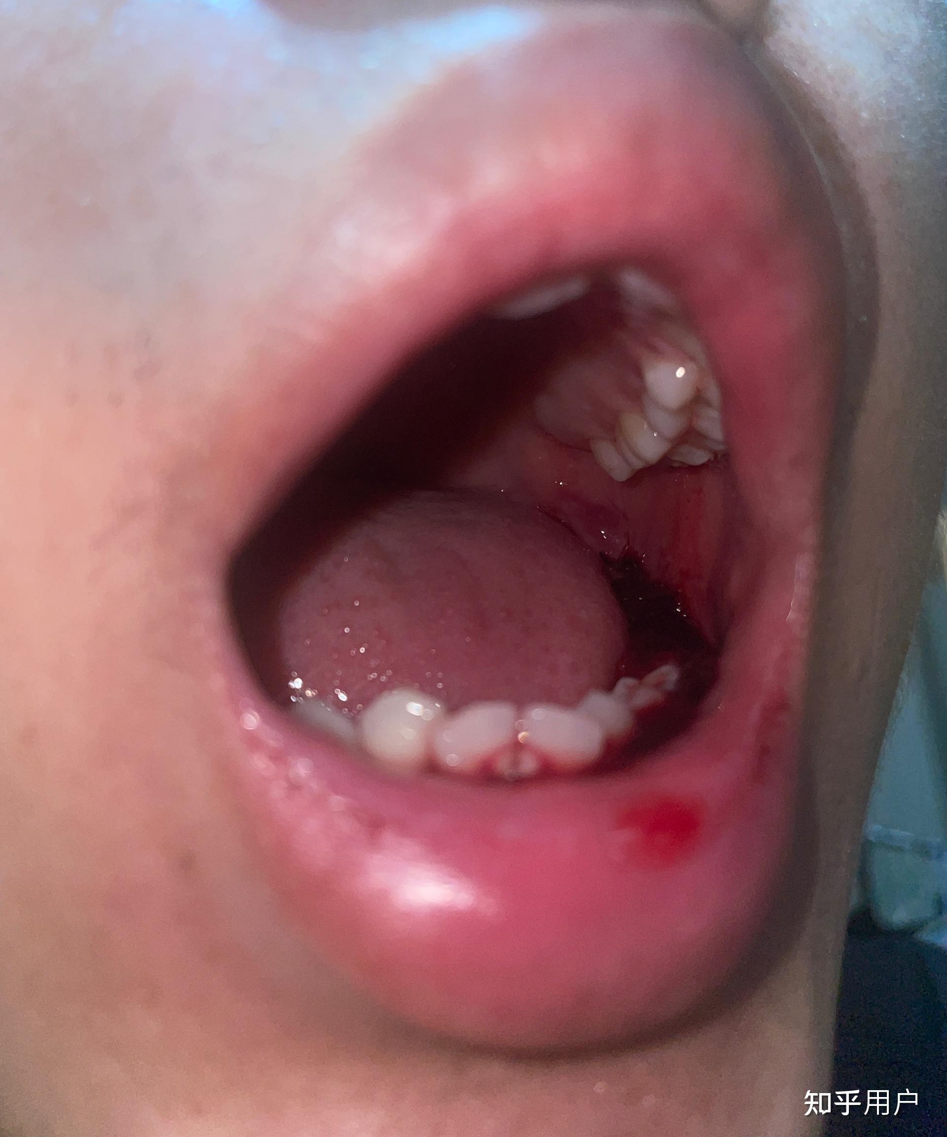 拔牙之后的血凝块几天后可以清理干净