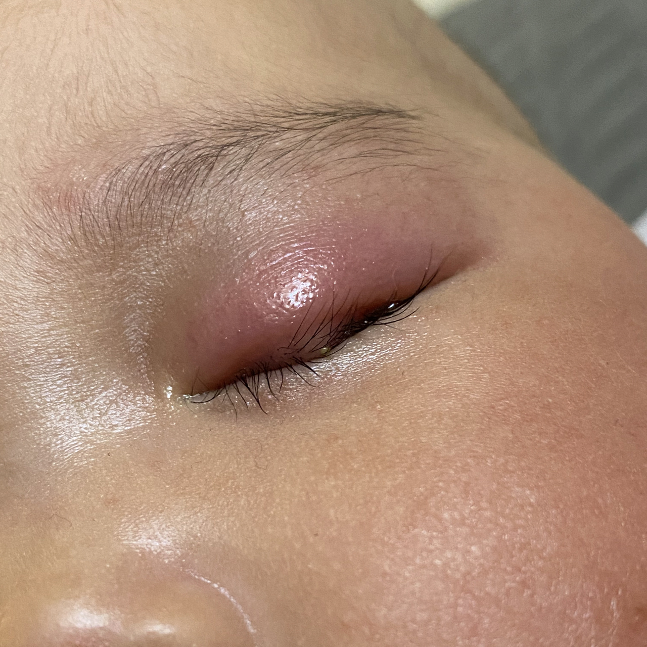 新生儿眼皮肿的图片图片