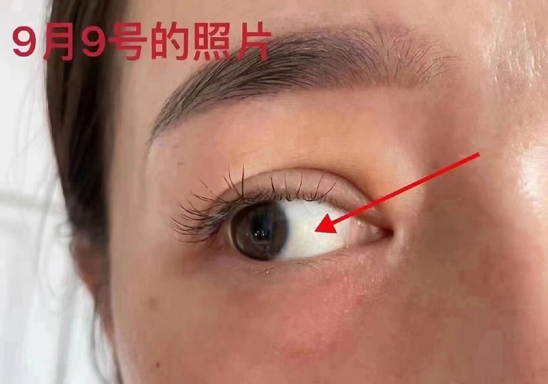 眼结膜增生十二天的效果