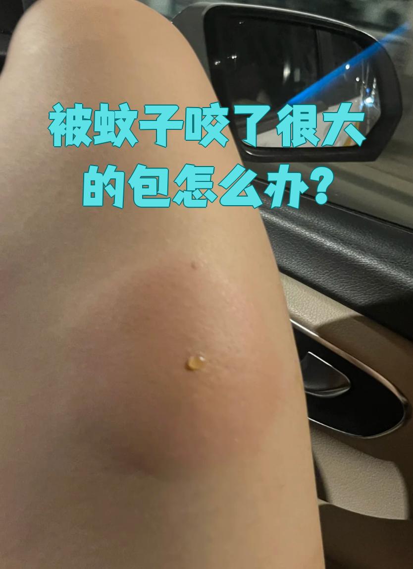 为什么被蚊子咬了会起包 为什么被蚊子咬了会起包