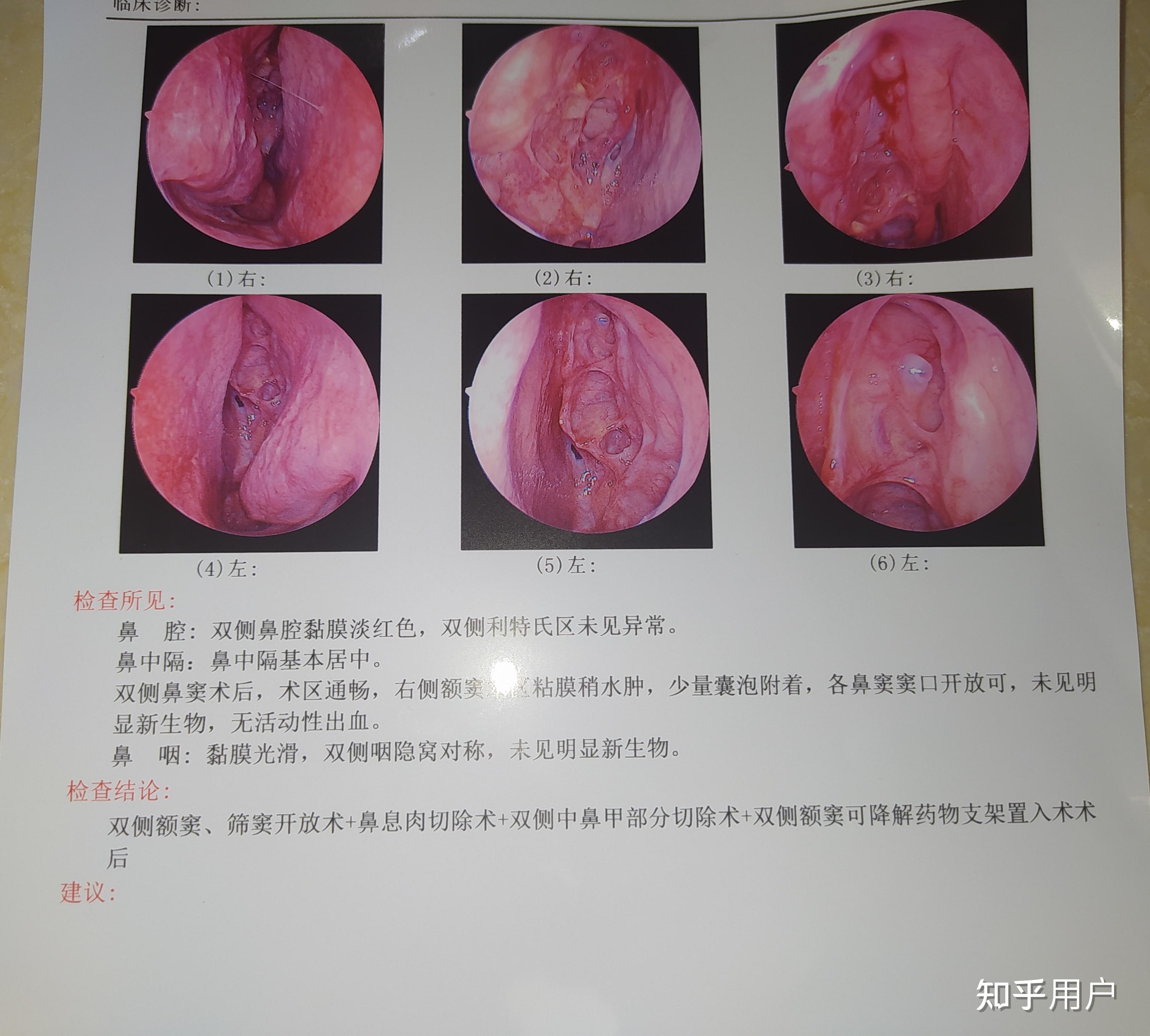 鼻窦炎有治好的吗分享一下真的很难受没心思做事情呜呜呜呜