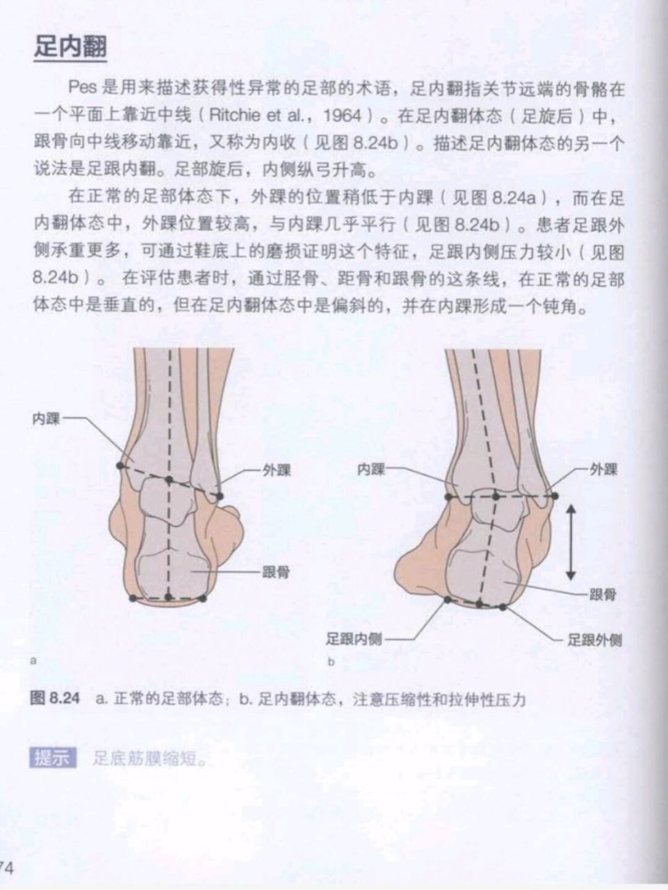 足旋前位图片