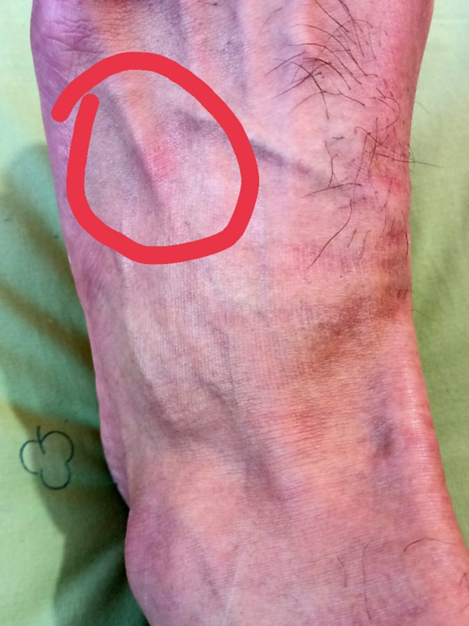 脚背痛,哪位大神知道怎么回事.