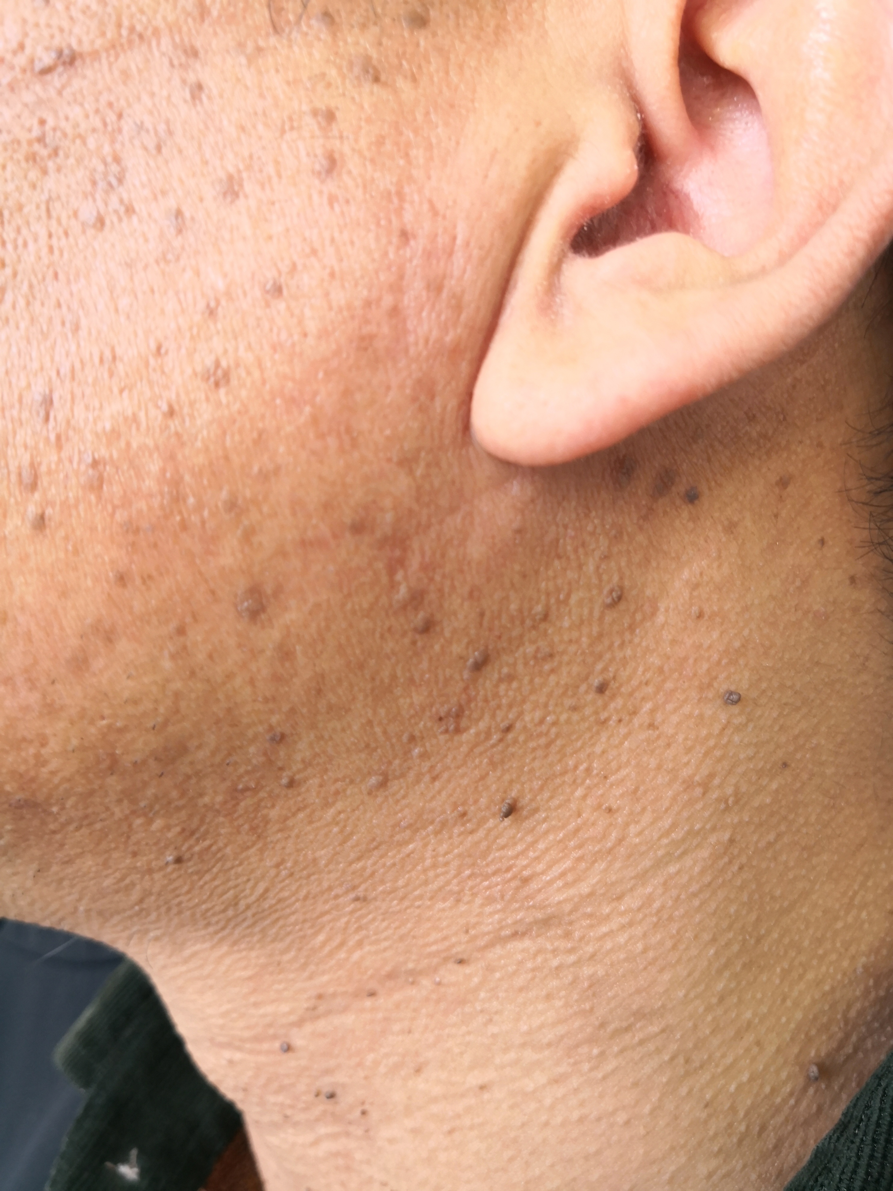 面颈部多发的角化型斑块.#脂溢性角化##老年斑