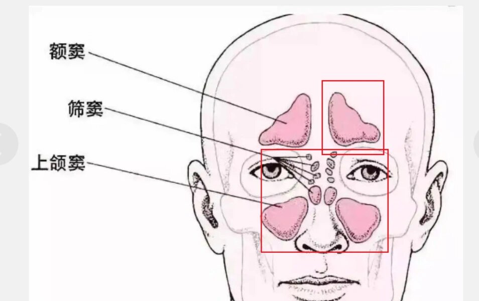 	 🥹患病可能原因推测: 慢性鼻炎患者上周不小心病毒