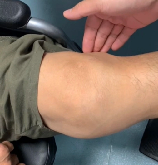 膝盖内侧出现硬包凸起且按压疼痛,常见原因包括膝关节半月板损伤ハ 